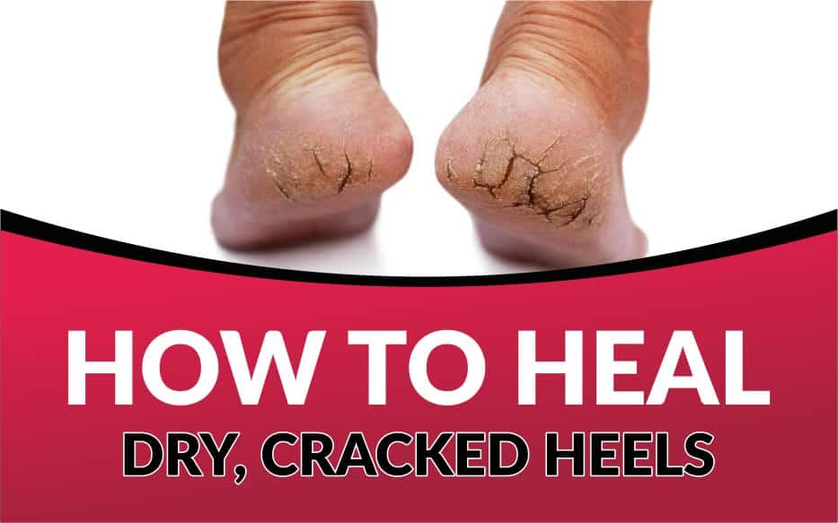 Eczema & Dry & Cracked Heels Treatment - Hand & Foot Cream+ by VGeneré-hkpdtq2012.edu.vn