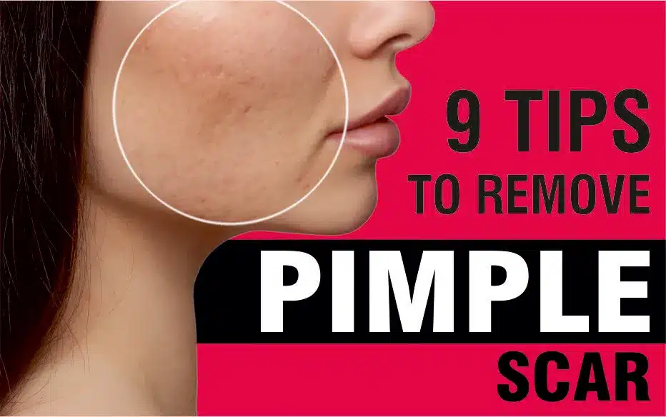 Pimple Scar