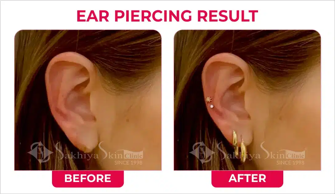 Ear Lobe Repair Surgery, Ear Lobe Repair Treatment - Sakhiya Skin Clinic