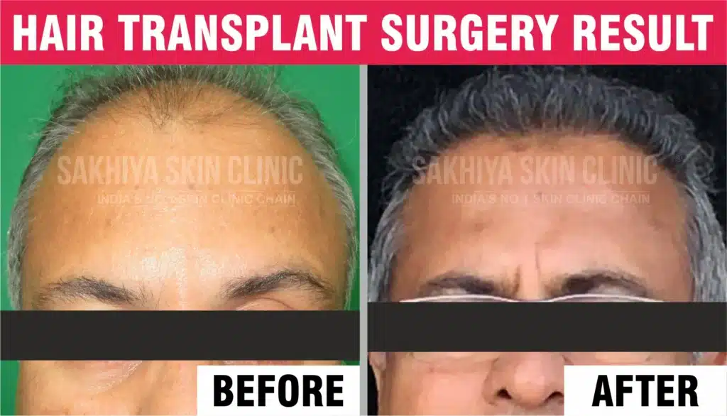 Hair transplant Before And After