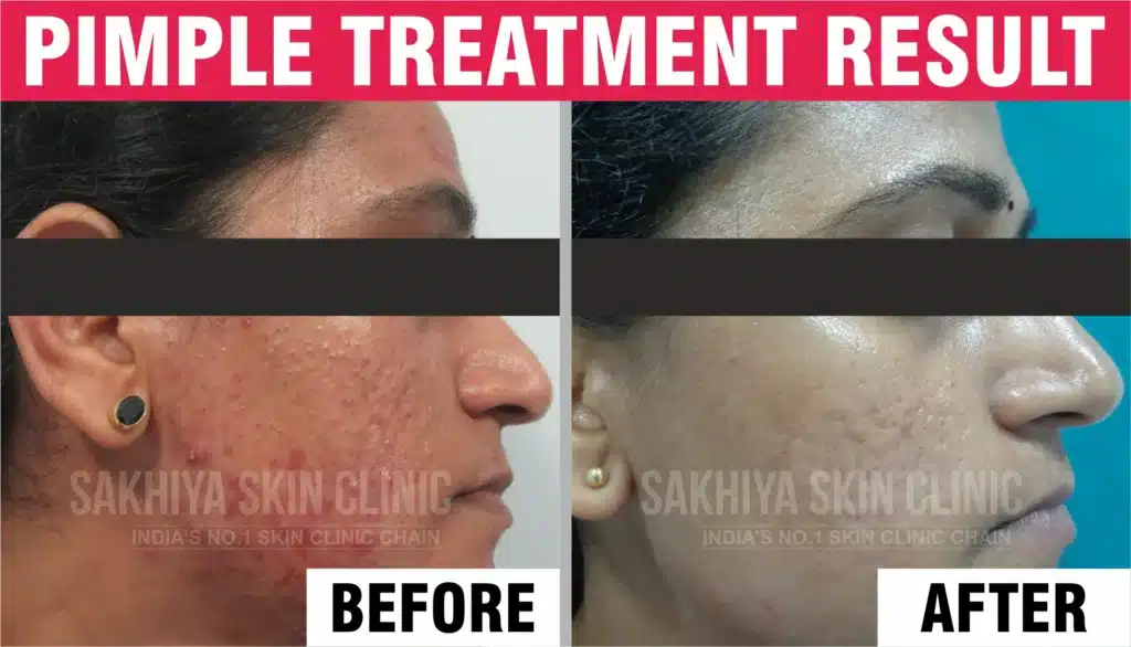 Pimple Treatment Before And After Result
