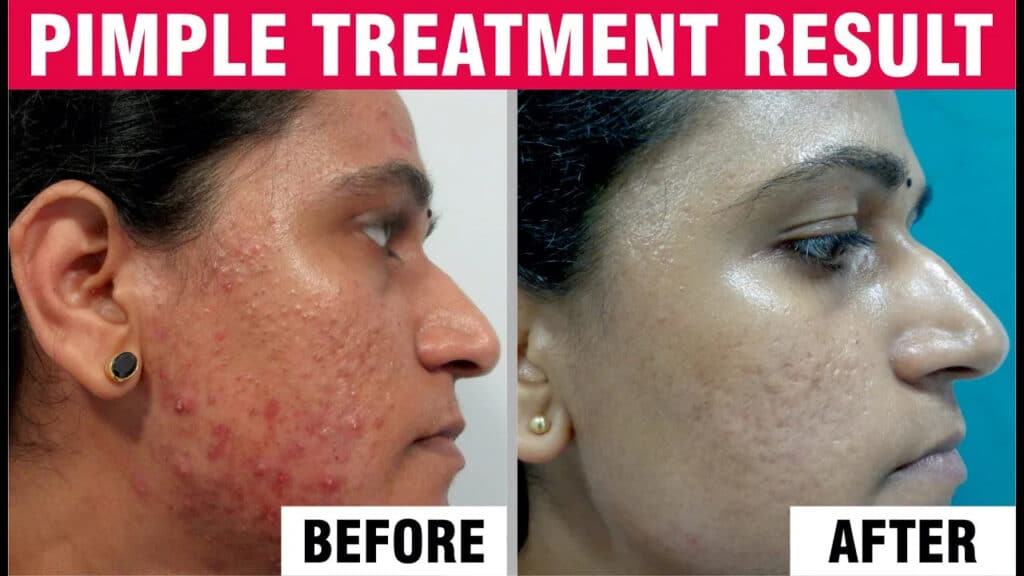 Acne & Acne Scar Treatment Feedback | Sakhiya Skin Clinic