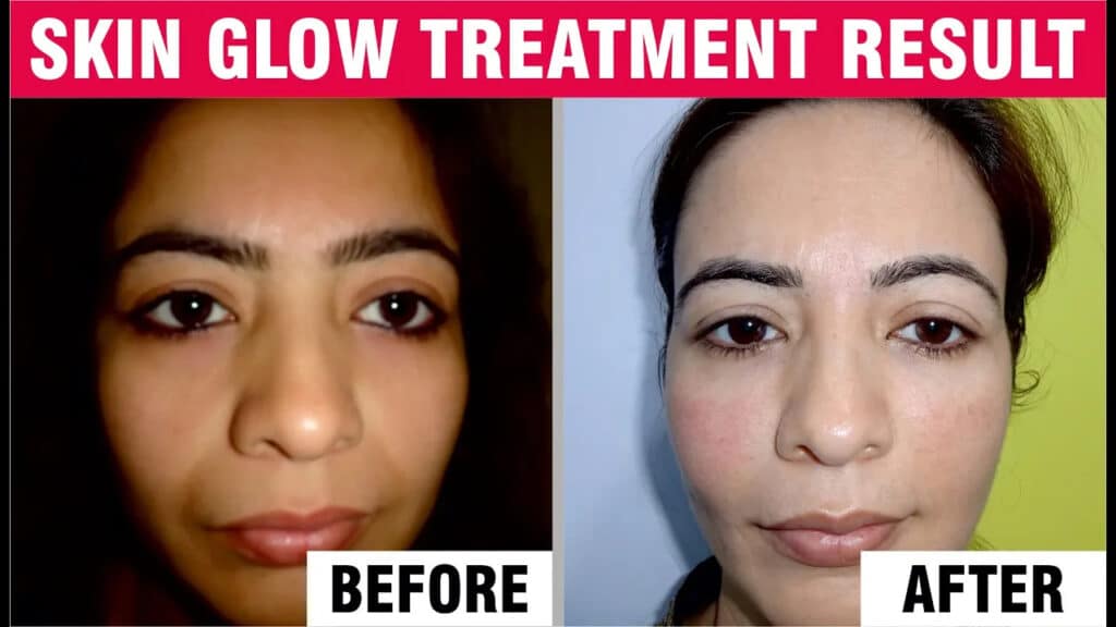 Acne & Acne Scar Treatment Feedback | Sakhiya Skin Clinic
