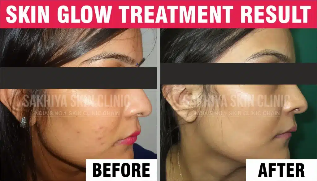 Skin Glow Treatment Before And After