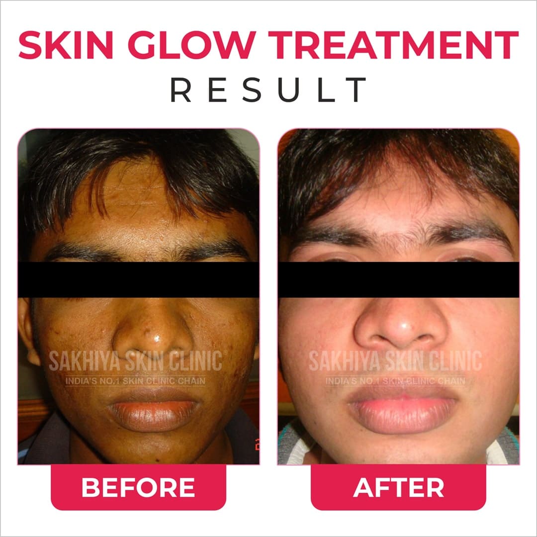 Skin Glow - Sakhiya Skin Clinic