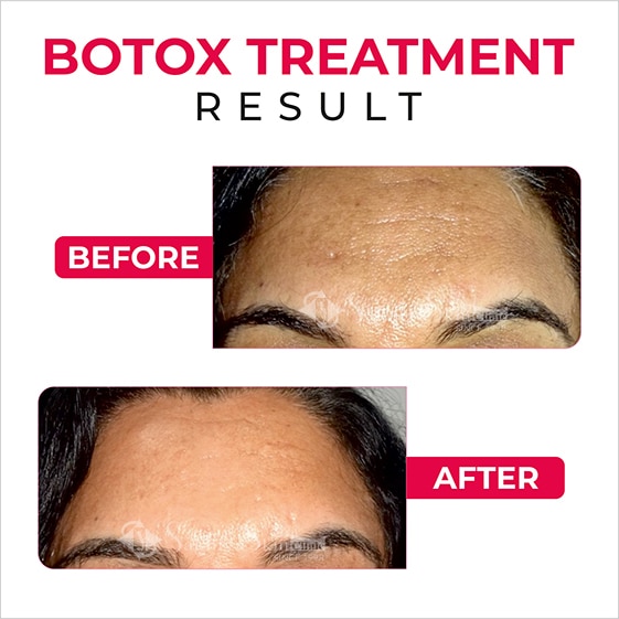 Before and After Result Of Botox Treatment (2)