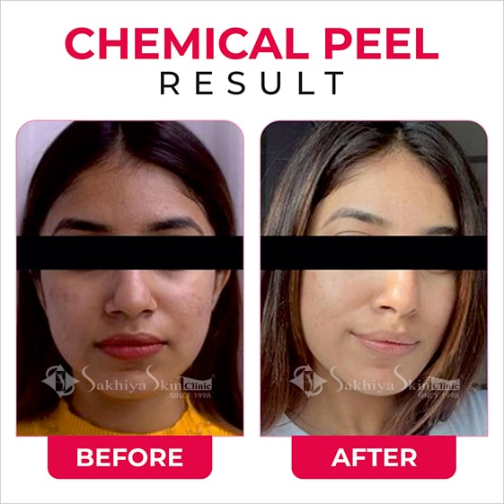 Before and After Result Of Chemical Peel Treatment