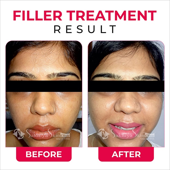 Before and After Result Of Filler Treatment (2)