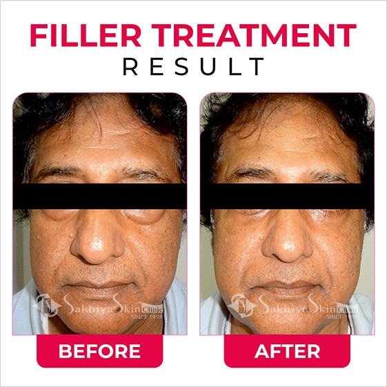 Before and After Result Of Filler Treatment (3)