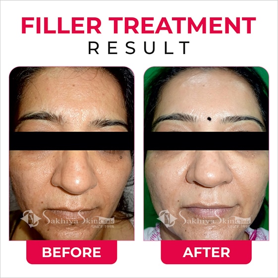 Before and After Result Of Filler Treatment