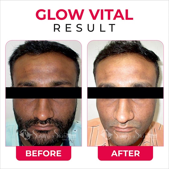 Before and After Result Of Glow Vital Laser Treatment