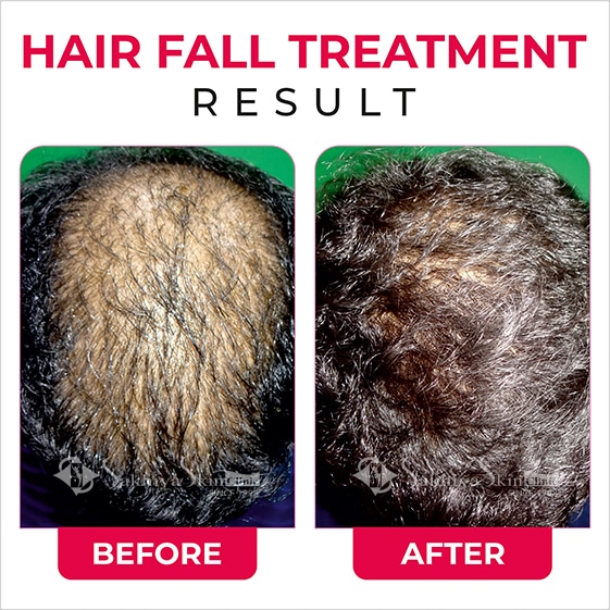 Before and After Result Of Hair Fall Treatment (2)
