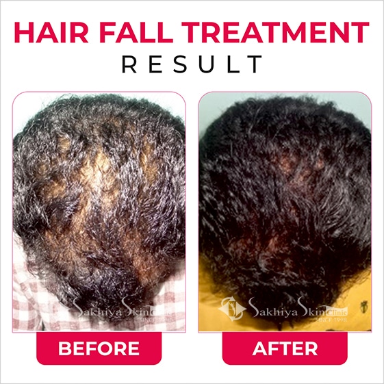 Before and After Result Of Hair Fall Treatment (3)
