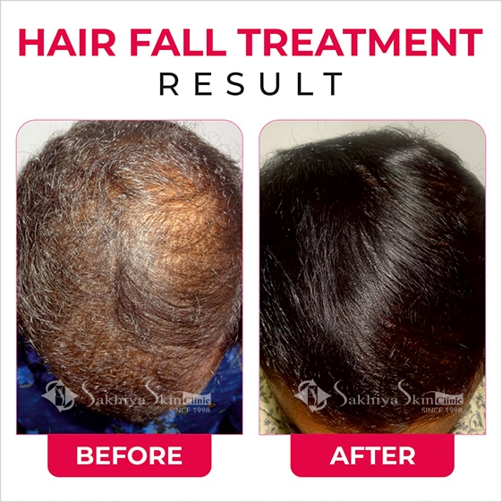 Before and After Result Of Hair Fall Treatment (4)