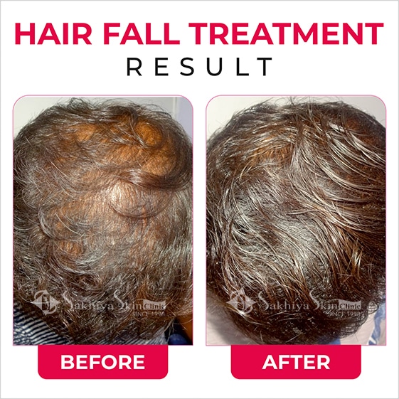 Before and After Result Of Hair Fall Treatment (5)