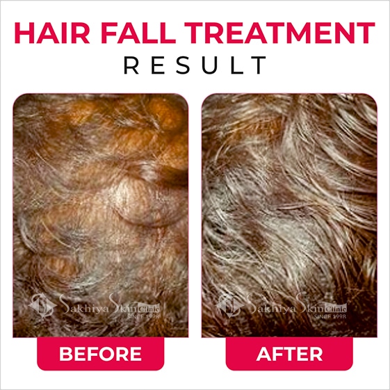 Before and After Result Of Hair Fall Treatment