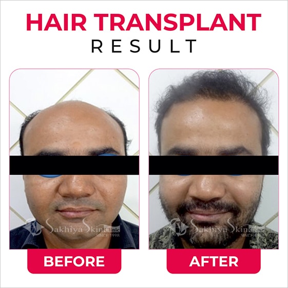 Before and After Result Of Hair Transplant Treatment (2)