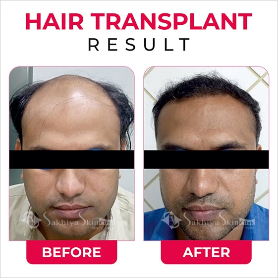 Before and After Result Of Hair Transplant Treatment (3)