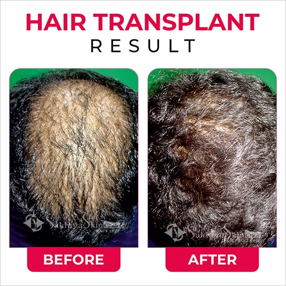 Before and After Result Of Hair Transplant Treatment (4)