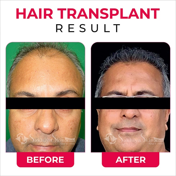 Before and After Result Of Hair Transplant Treatment (5)