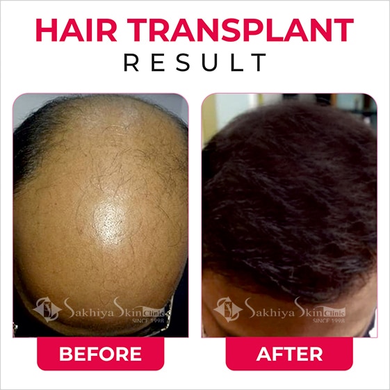Before and After Result Of Hair Transplant Treatment