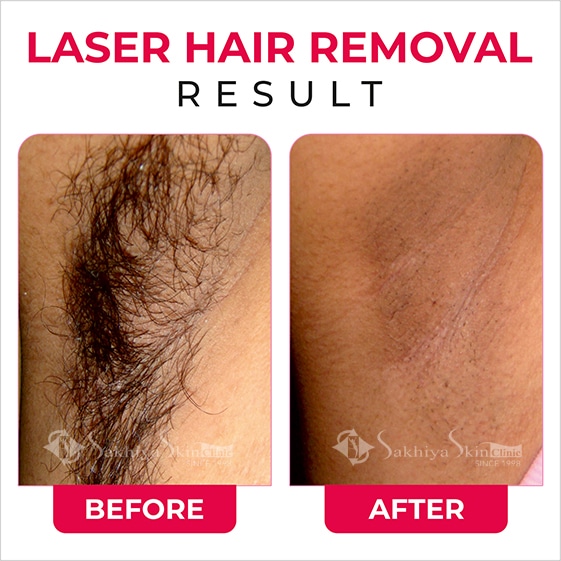 Before and After Result Of Laser hair Removal (2)