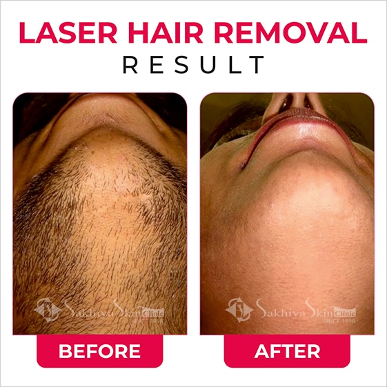 Before and After Result Of Laser hair Removal (3)