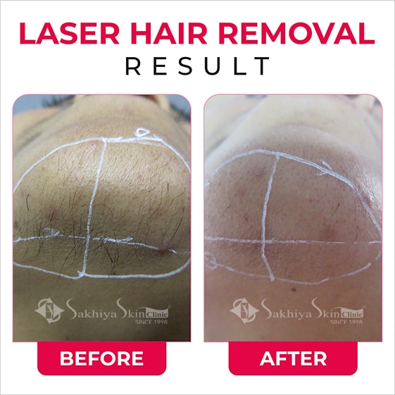 Before and After Result Of Laser hair Removal (4)