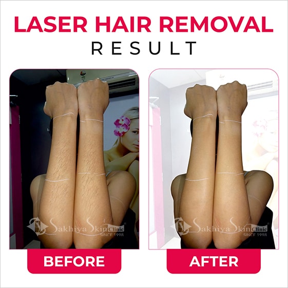 Before and After Result Of Laser hair Removal (5)