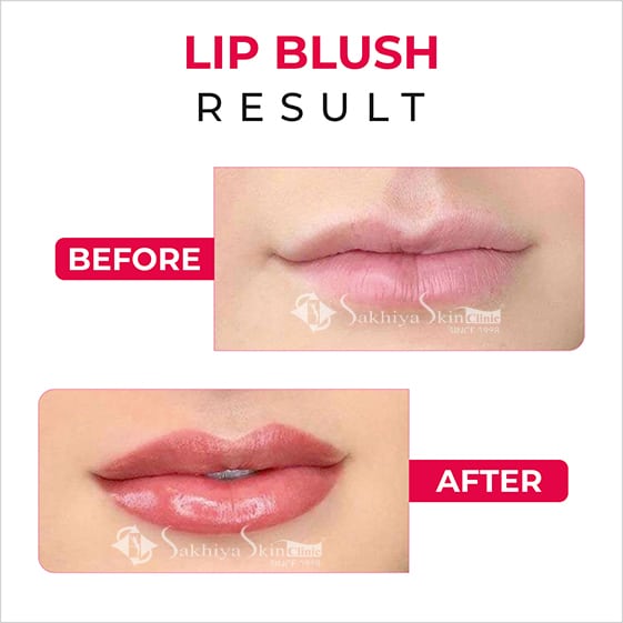 Before and After Result Of Lip Blush Treatment (2)