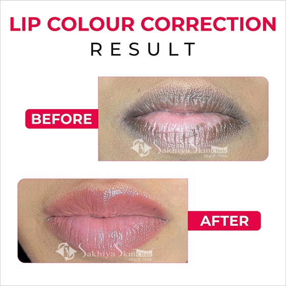Before and After Result Of Lip Blush Treatment (4)