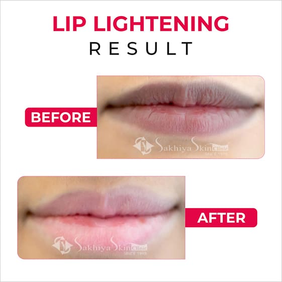 Before and After Result Of Lip Blush Treatment
