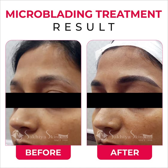 Before and After Result Of Microblading (Permanent Eyebrows) Treatment (2)