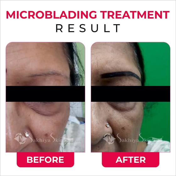Before and After Result Of Microblading (Permanent Eyebrows) Treatment (3)