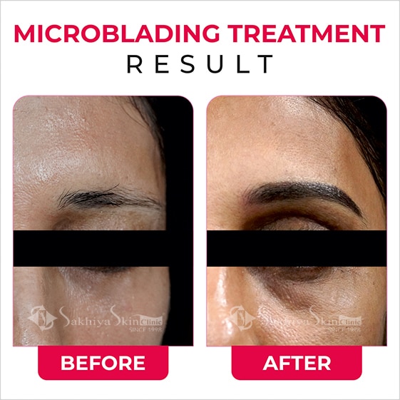 Before and After Result Of Microblading (Permanent Eyebrows) Treatment