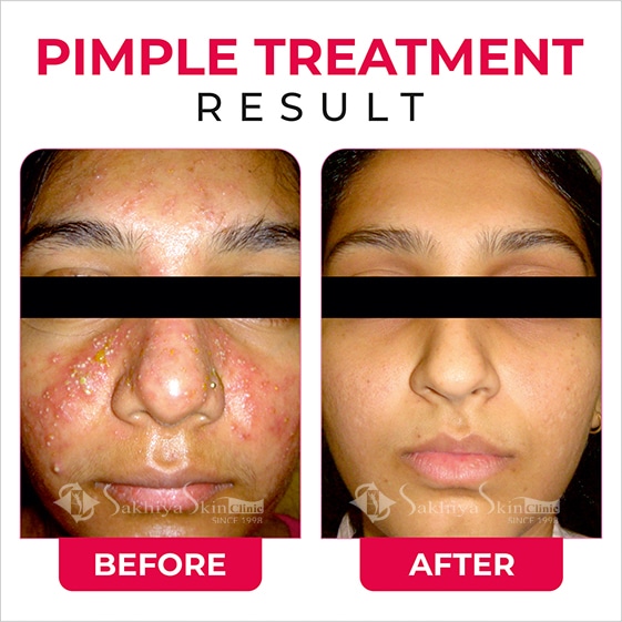 Before and After Result Of Pimples Treatment (2)