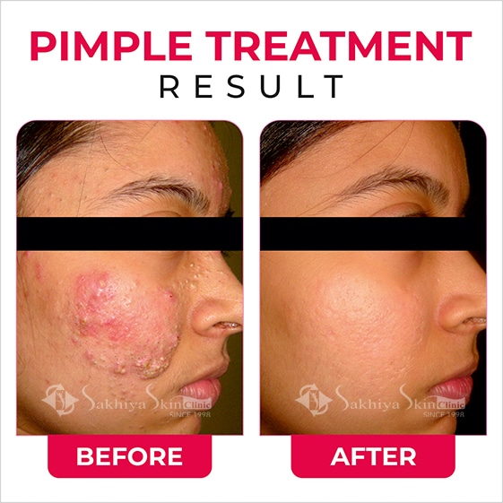 Before and After Result Of Pimples Treatment (3)