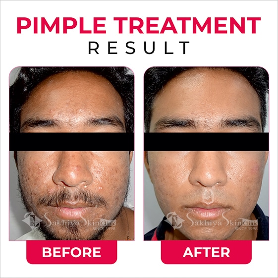 Before and After Result Of Pimples Treatment (4)