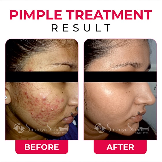 Before and After Result Of Pimples Treatment (5)
