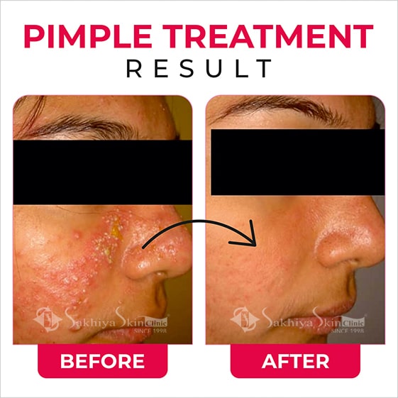 Before and After Result Of Pimples Treatment