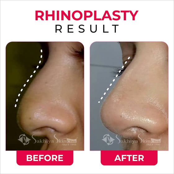 Before and After Result Of Rhinoplasty Nose Surgery