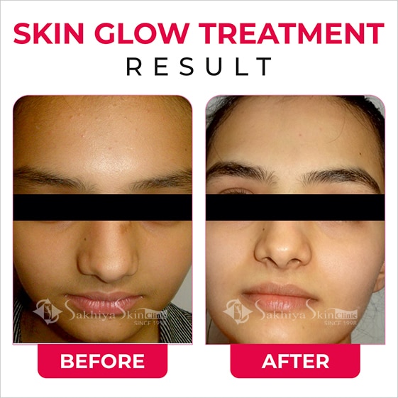Before and After Result Of Skin Glow Treatment (2)