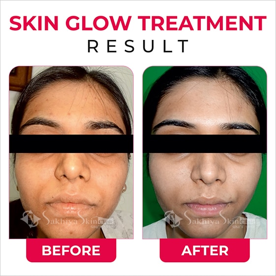 Before and After Result Of Skin Glow Treatment (3)
