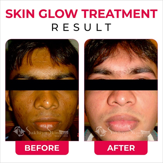 Before and After Result Of Skin Glow Treatment (4)