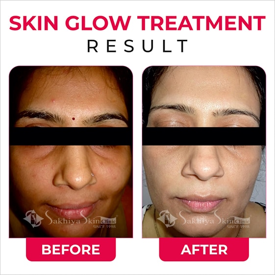 Before and After Result Of Skin Glow Treatment (5)
