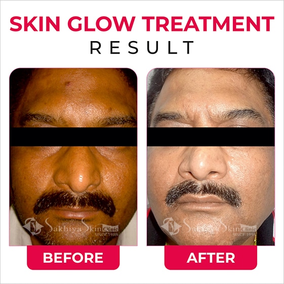 Before and After Result Of Skin Glow Treatment