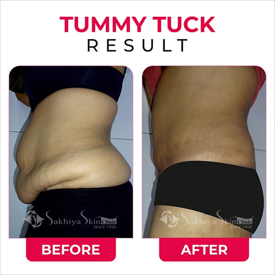 Before and After Result Of Tummy Tuck Surgery