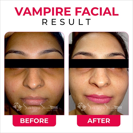 Before and After Result Of Vampire Facial
