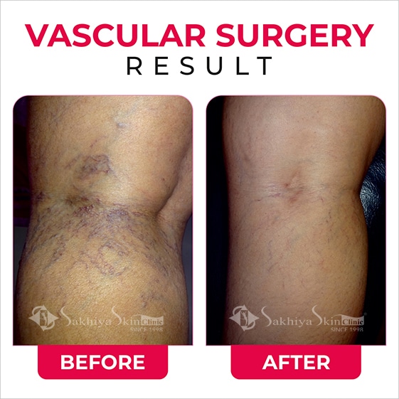 Before and After Result Of Vascular Surgery