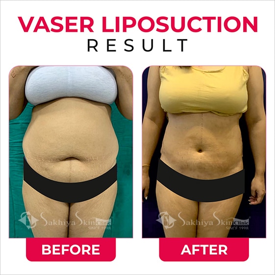 Before and After Result Of Vaser Liposuction